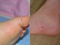 Nốt ruồi ở chân – Những vị trí nốt ruồi ở chân mang đến điềm tốt lành