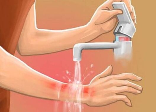 Giải mã nằm mơ thấy bỏng nước sôi là điềm báo gì? Đánh số mấy